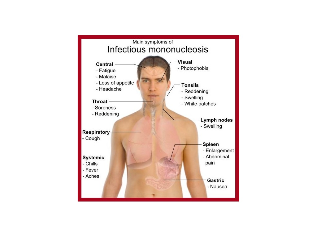 Мононуклеоз у детей картинки