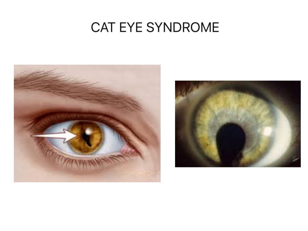 Cat Eye Syndrome Science Showme