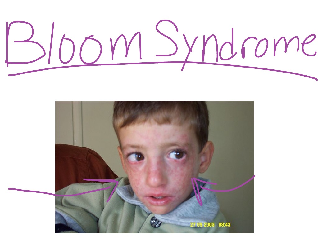 bloom syndrome