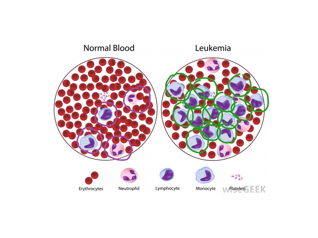 Chronic myeloid leukemia (alexia and Rachel) | Science, Health | ShowMe