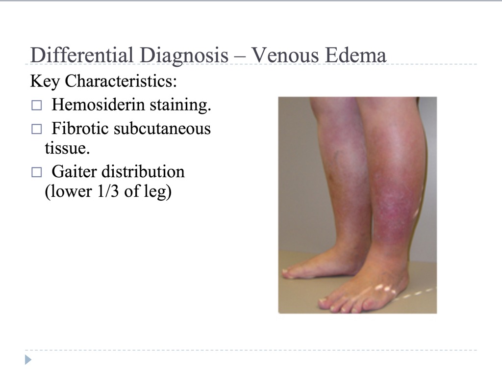 Lymphadema Hemosiderin Staining Legs